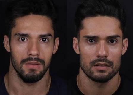 Veja O Antes E Depois De Famosos Que Fizeram Harmoniza O Facial Portal O Norte