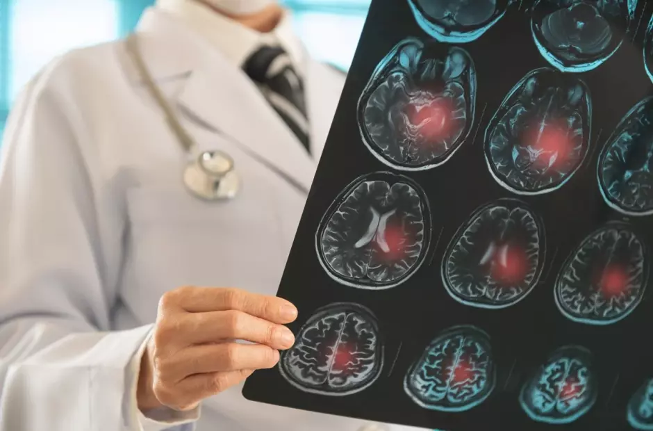  Se você sentir esses sintomas cuidado que pode ser alerta de AVC 