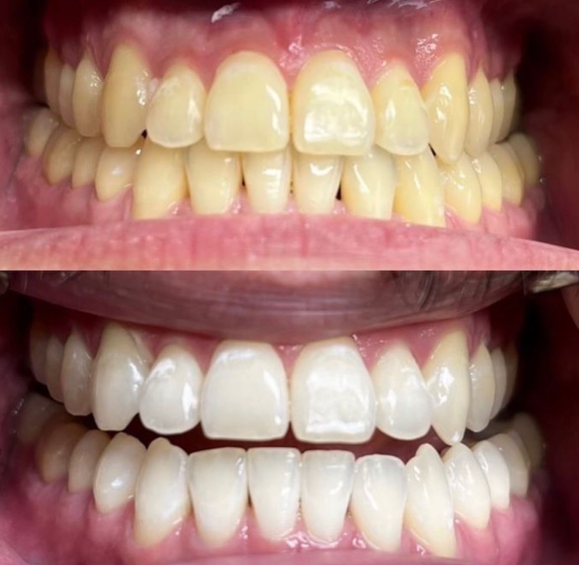 Cirurgiã Dentista Revela 7 Mitos E Verdades Sobre O Clareamento Dental ...